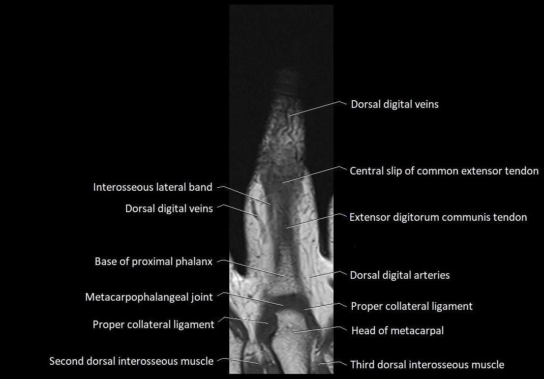 Finger anatomy coronal cross section 3TMRI labelled  image 3.webp
